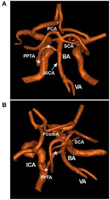 Clinical Importance of the Persistent Primitive Trigeminal Artery in Vascular Lesions and Its Role in Endovascular Treatment